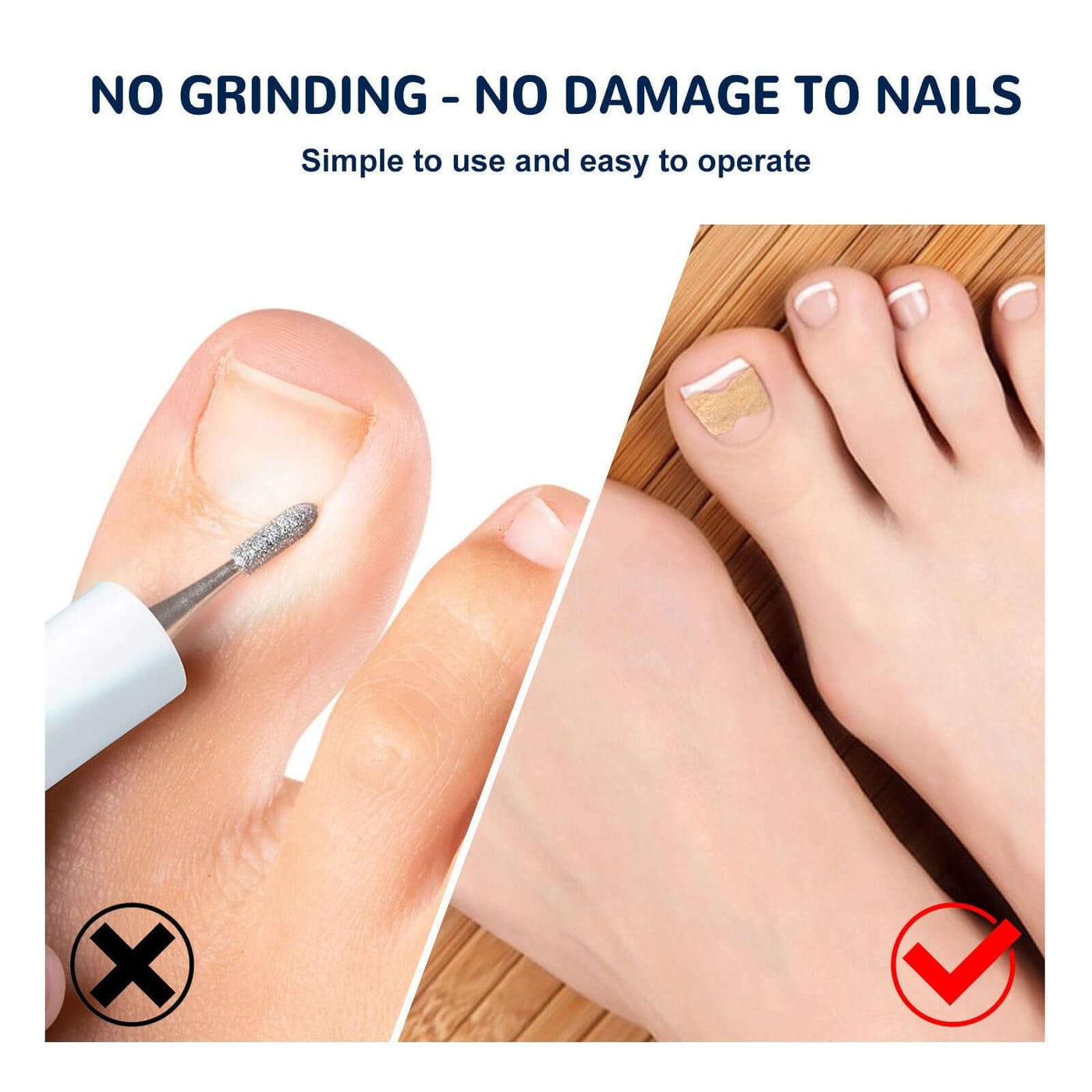 Toenail Corrective Patch Repair Embedded Nails - Mrgoluckynow Toenail Corrective Patch Repair Embedded Nails0Mrgoluckynow CJJT171991502BY