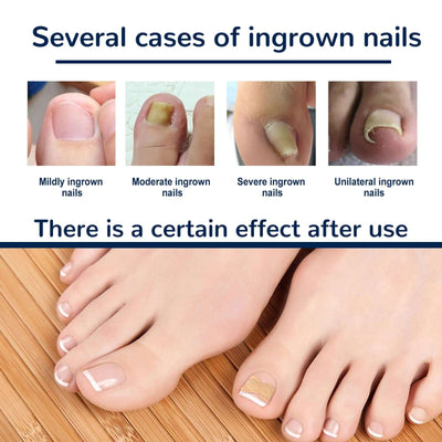 Toenail Corrective Patch Repair Embedded Nails - Mrgoluckynow Toenail Corrective Patch Repair Embedded Nails0Mrgoluckynow CJJT171991502BY